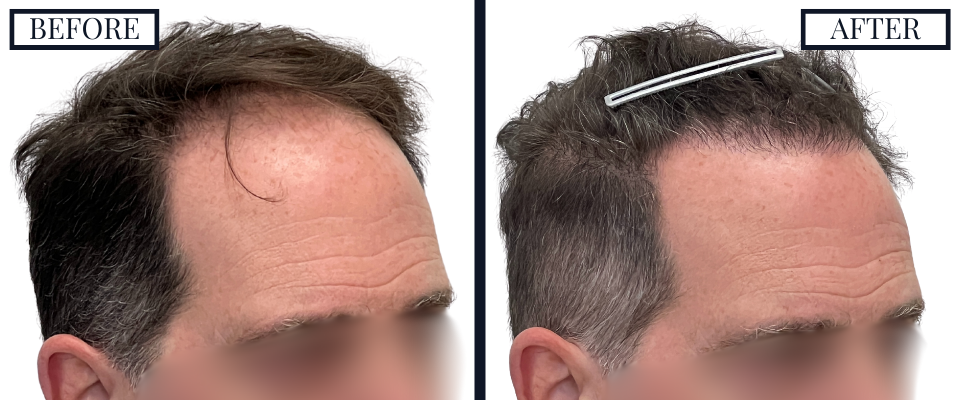 3059 FUE - Before and After RIGHT OBLIQUE VIEW