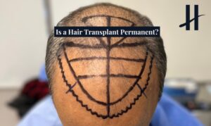 Hair Transplant Permanent - THTS