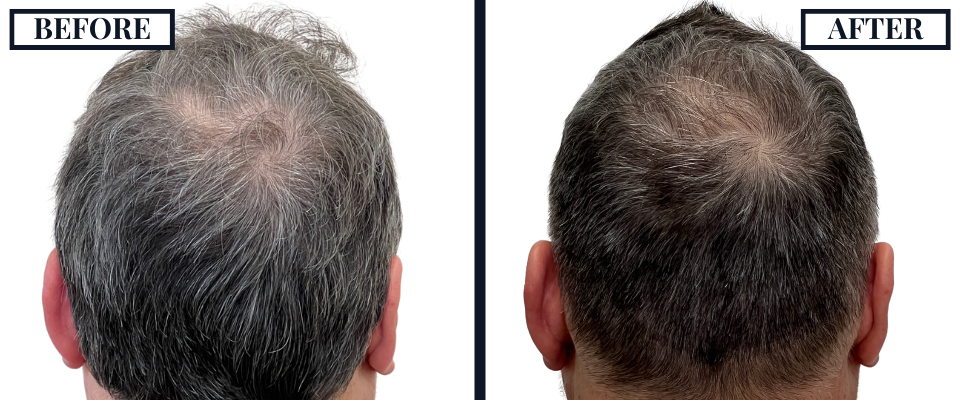 1526 GRAFT FUE BEFORE AND AFTER