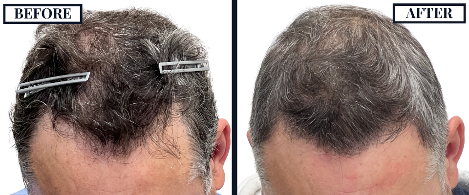 1526 GRAFT FUE BEFORE AND AFTER