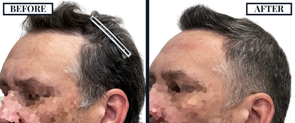 1526 GRAFT FUE BEFORE AND AFTER