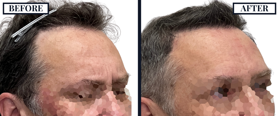 1526 GRAFT FUE BEFORE AND AFTER