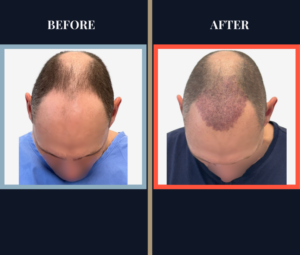 Post-Op Recovery Timeline 2277 G FUE