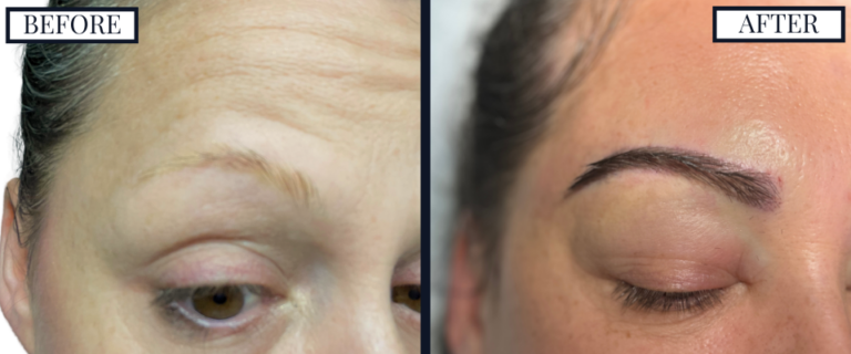 900 G FUT EYEBROW HAIR TRANSPLANT