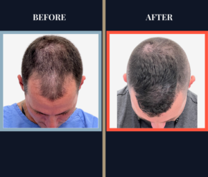 1501 Graft FUE BEFORE AND AFTER