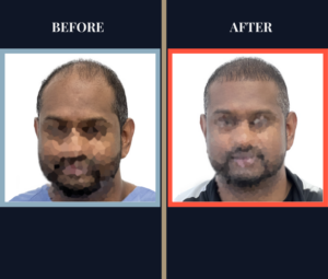 1516 Graft FUE Before and After Photo