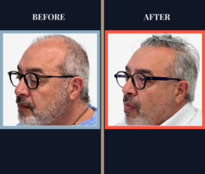 2006 Graft FUE Before and After