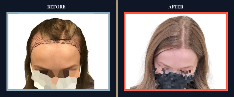 Hair Transplant Before & After Results