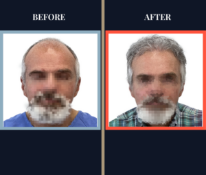 1509 graft fue hair transplant