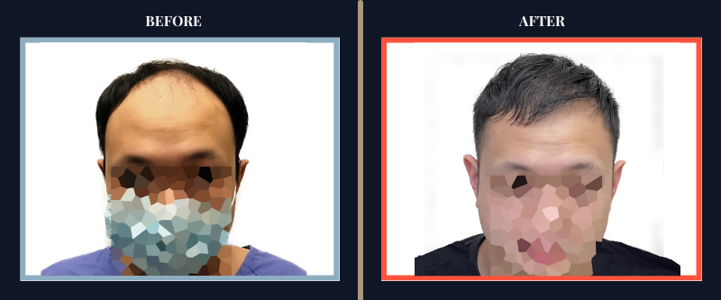 Hair Transplant Before & After Results