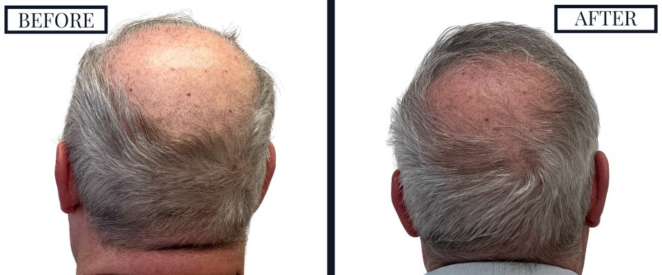 2018 Graft FUE Hair Transplant