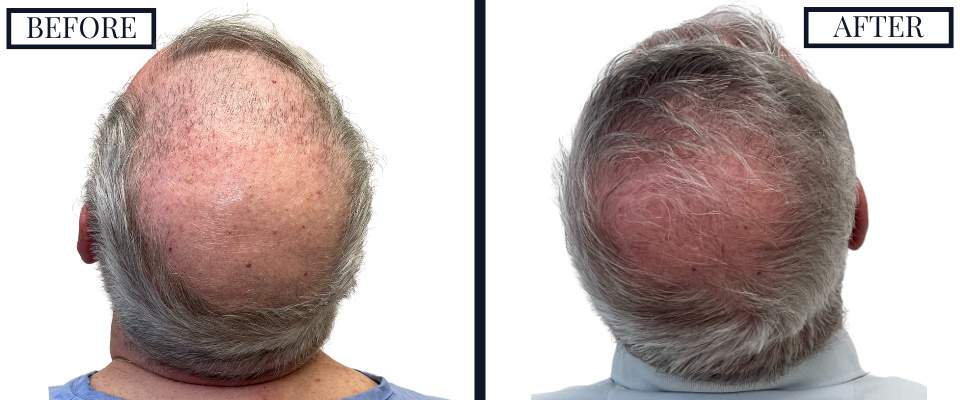 2018 Graft FUE Hair Transplant