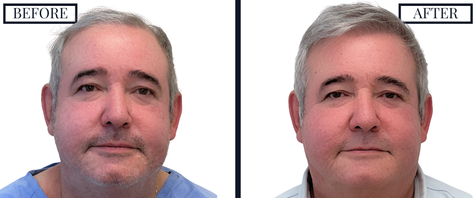 2018 Graft FUE Hair Transplant