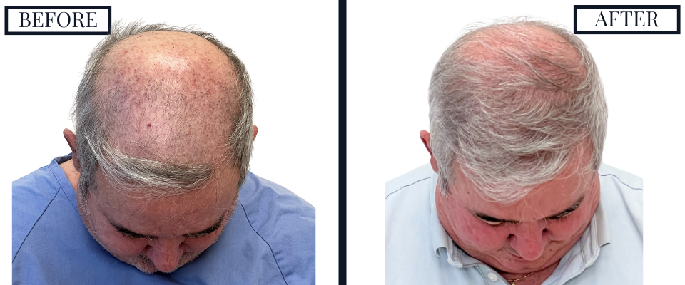 2018 Graft FUE Hair Transplant