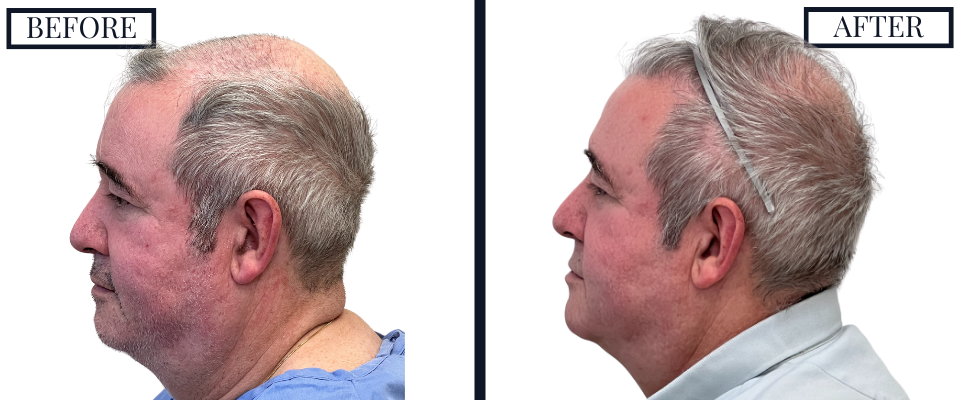 2018 Graft FUE Hair Transplant