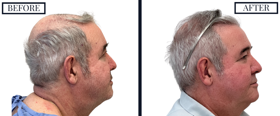 2018 Graft FUE Hair Transplant