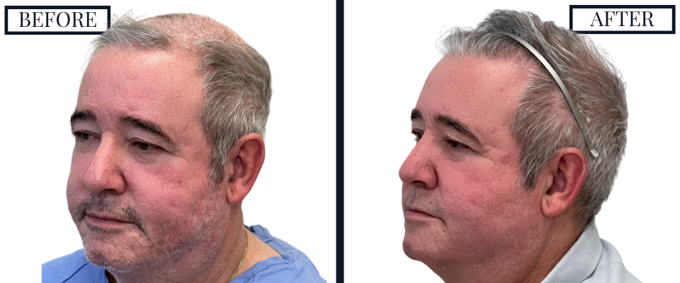 2018 Graft FUE Hair Transplant