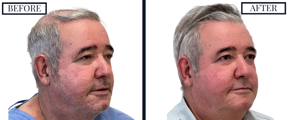 2018 Graft FUE Hair Transplant