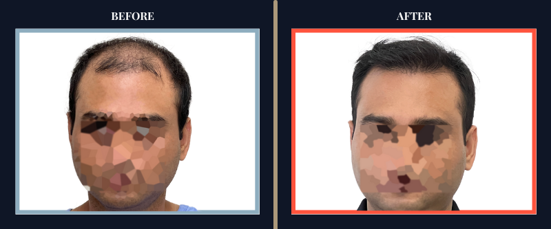 Hair Transplant Before & After Results