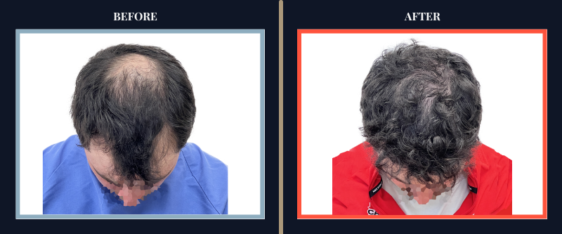 Hair Transplant Before & After Results