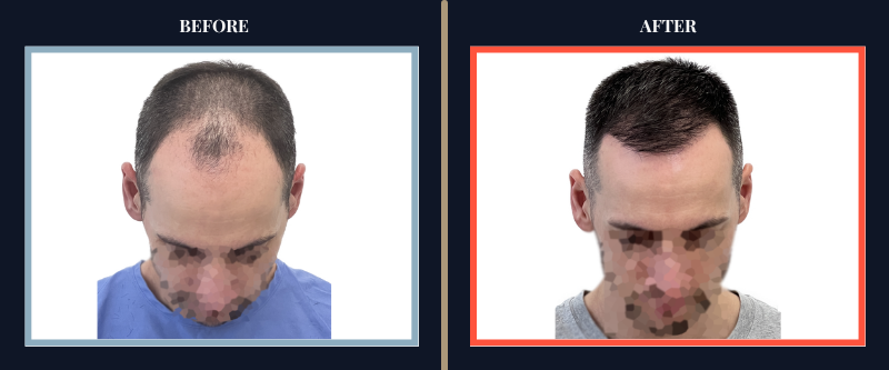 Hair Transplant Before & After Results