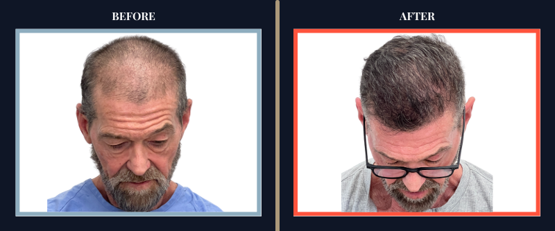 Hair Transplant Before & After Results