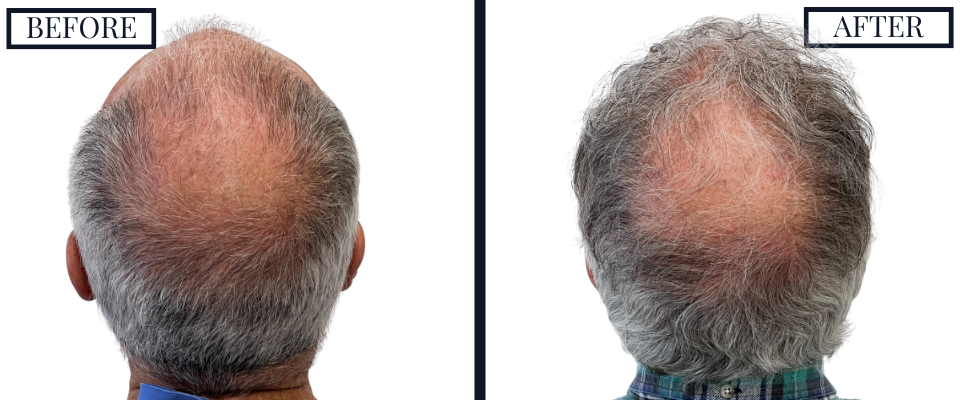 1509 graft fue hair transplant