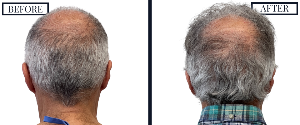 1509 graft fue hair transplant