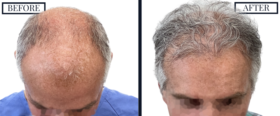 1509 graft fue hair transplant