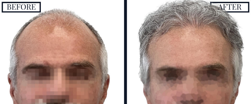 1509 graft fue hair transplant