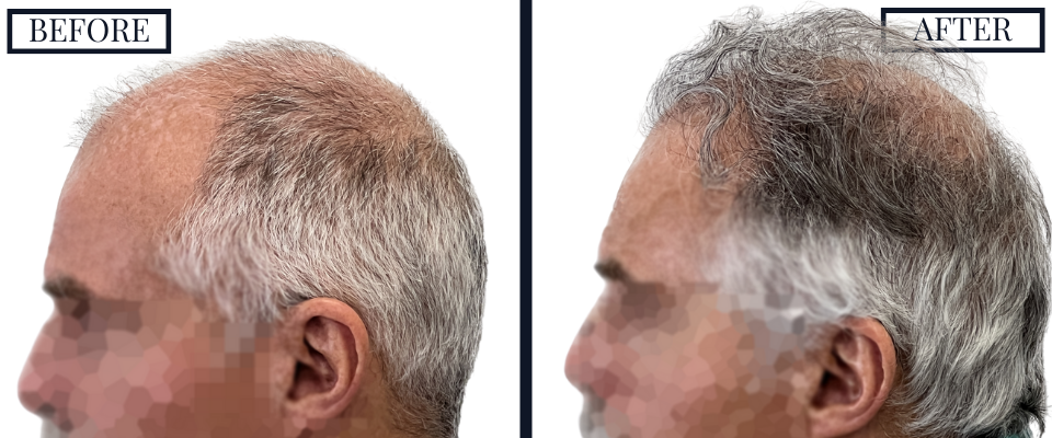1509 graft fue hair transplant