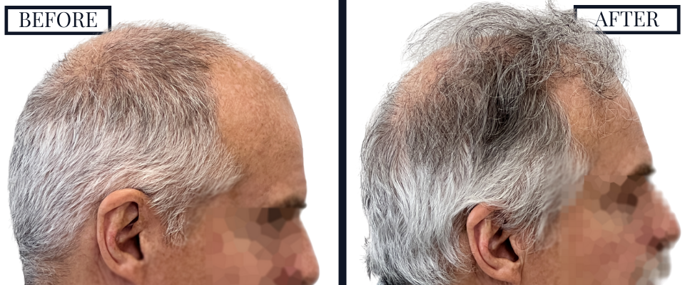 1509 graft fue hair transplant