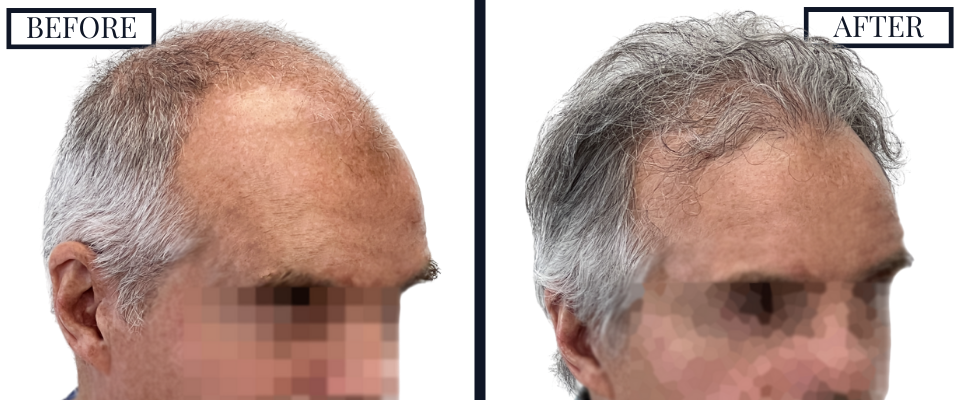 1509 graft fue hair transplant
