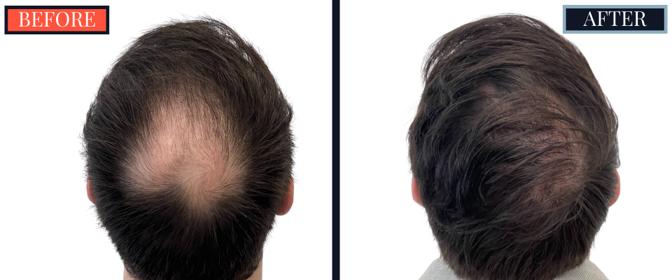 2008 GRAFT FUE RESULTS BEFORE AND AFTER