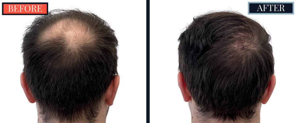 2008 GRAFT FUE RESULTS BEFORE AND AFTER