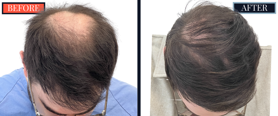 2008 GRAFT FUE RESULTS BEFORE AND AFTER