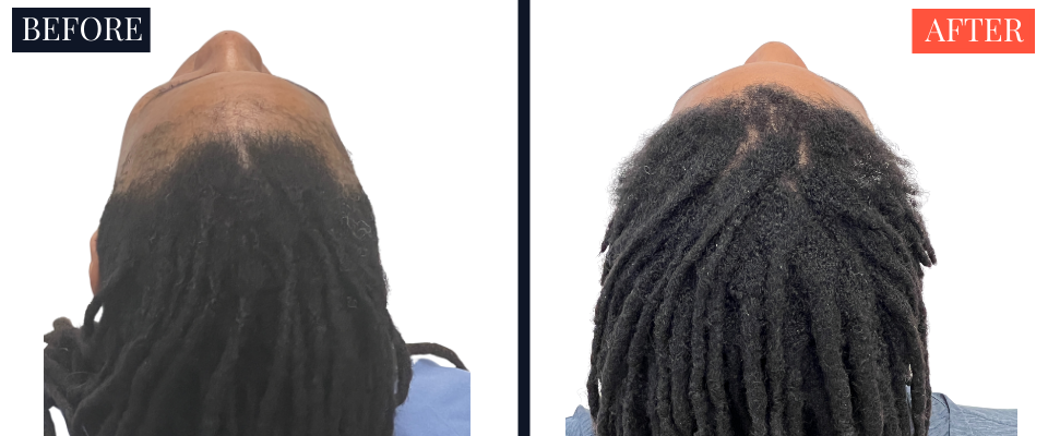 2004 Graft FUT Strip Hair Transplant Before and After - Traction Alopecia