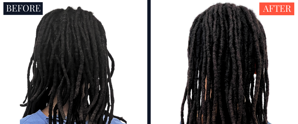 2004 Graft FUT Strip Hair Transplant Before and After - Traction Alopecia