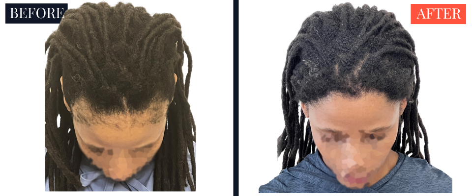 2004 Graft FUT Strip Hair Transplant Before and After - Traction Alopecia