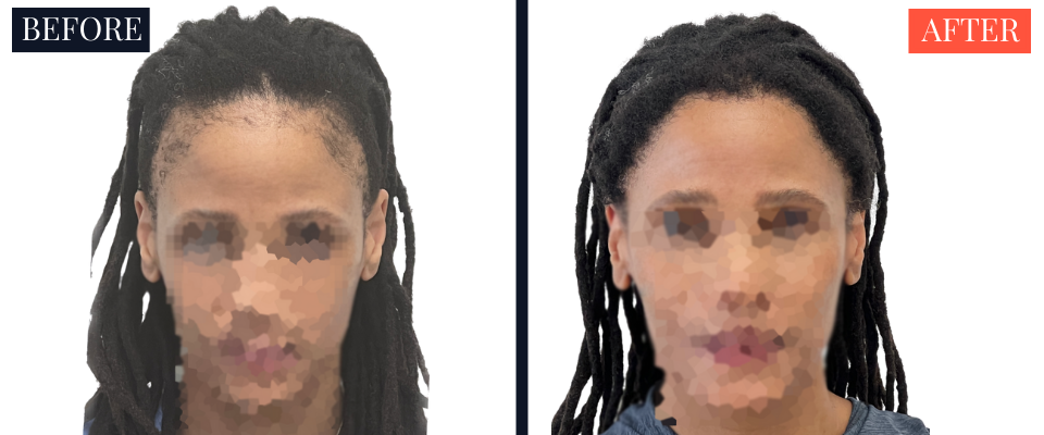 2004 Graft FUT Strip Hair Transplant Before and After - Traction Alopecia