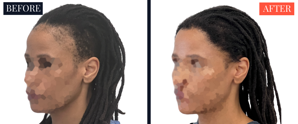 2004 Graft FUT Strip Hair Transplant Before and After - Traction Alopecia
