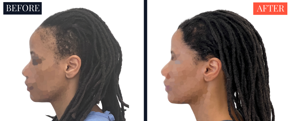 2004 Graft FUT Strip Hair Transplant Before and After - Traction Alopecia