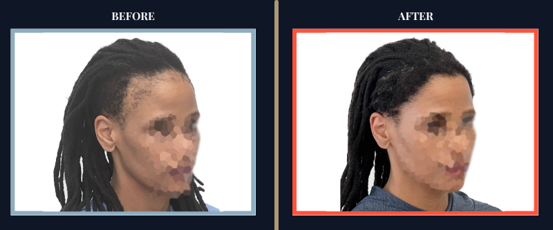 Hair Transplant Before & After Results