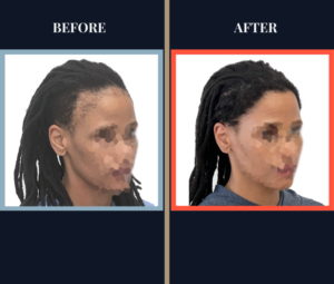 2004 Graft FUT Strip Hair Transplant Before and After - Traction Alopecia