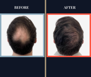 2008 GRAFT FUE RESULTS BEFORE AND AFTER
