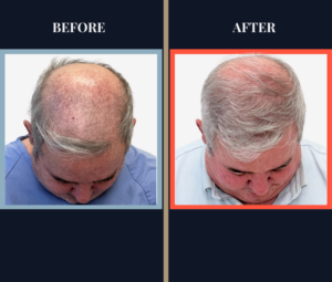 2018 Graft FUE Hair Transplant