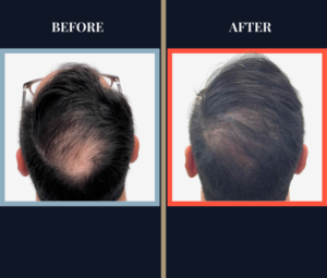 3286 Graft FUT Hair Transplant