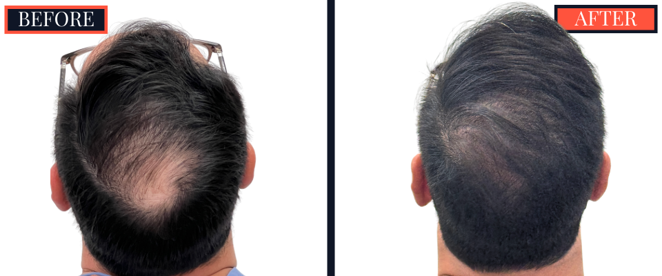 3286 Graft FUT Hair Transplant