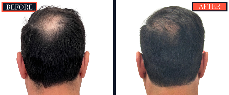 3286 Graft FUT Hair Transplant