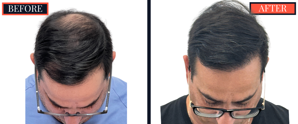 3286 Graft FUT Hair Transplant